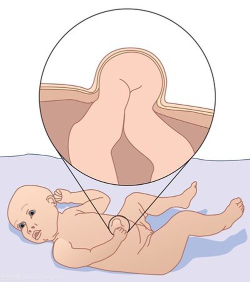 脐疝、王大膏药
